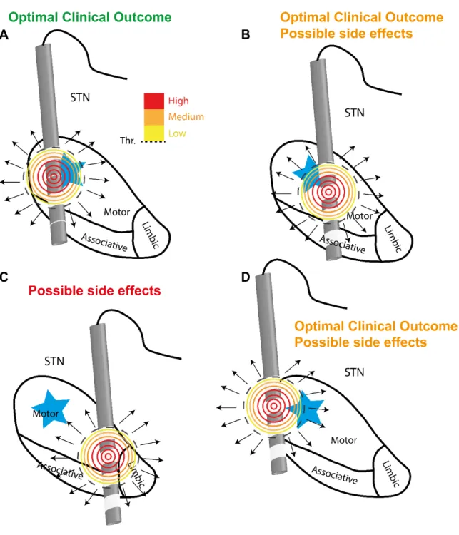 Figure 2.1 Qualitative explanation of the importance of the position of the active contact in DBS STN  for PD