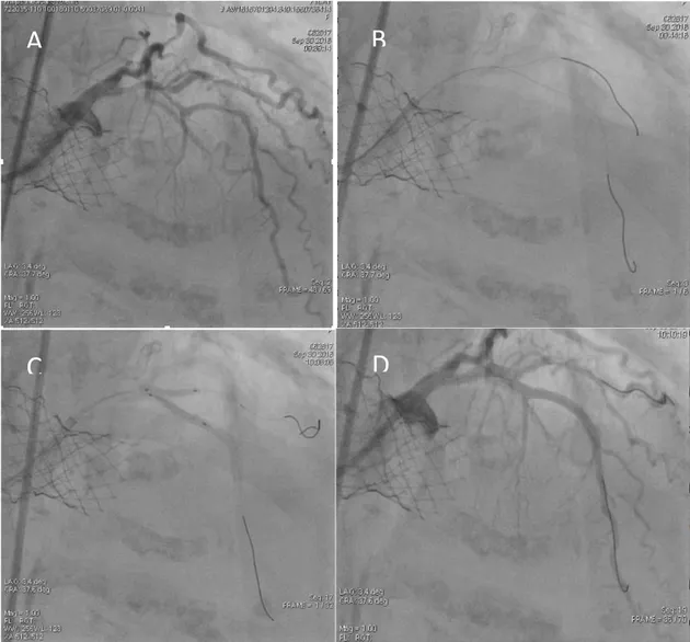 Figura 1. (A) Angiogramma non selettiva con catetere EBU attraverso le maglie del frame 