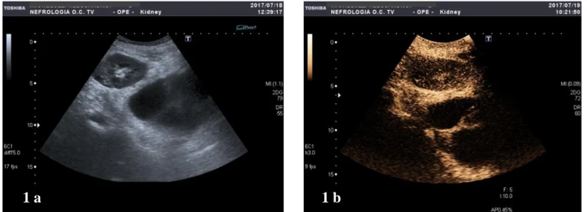 Figura 1. (A) Immagine in B-Mode, raccolta complessa al di sotto del rene trapiantato, dislocante la vescica