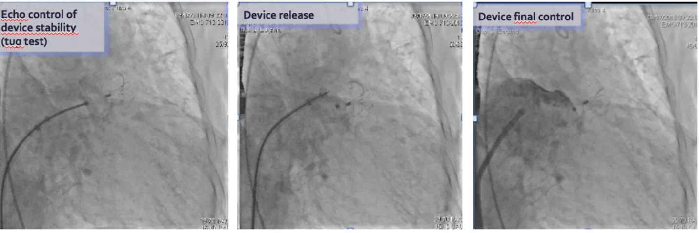 Fig 20                                           Fig 21                                             Fig 22 Aortic valvuloplasty with 