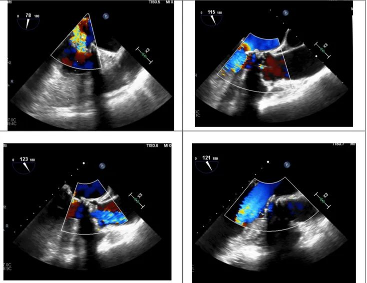 Fig. 6- Ecocardiogramma trans-esofageo pre e post-procedura  