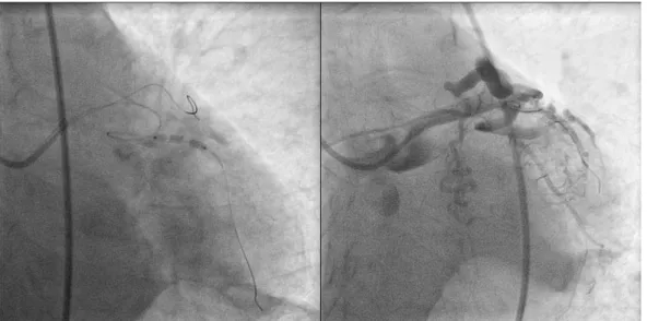 Fig. 4: a sinistra: PTCA con pallone Tazuna 3,0 x 15 mm su Cx; a destra: mancato  ripristino del flusso coronarico nonostante PTCA e tromboaspirazione