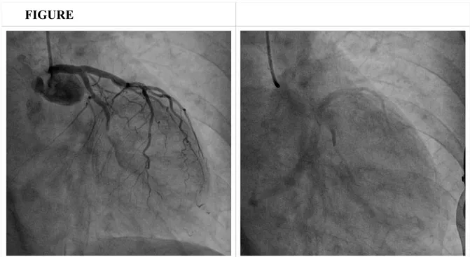 Figura  1.  Angiografia  coronarica  sinsitra.  Occlusione  del  segmento  medio  del  ramo  circonflesso, con immagine di “Dye staining” a monte e valle della lesione occlusiva