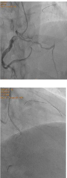 Figura  5: pre-dilatazione  su  lesione  prossimale  di IVA e successivo trattamento con DCB 3.0-20  mm.