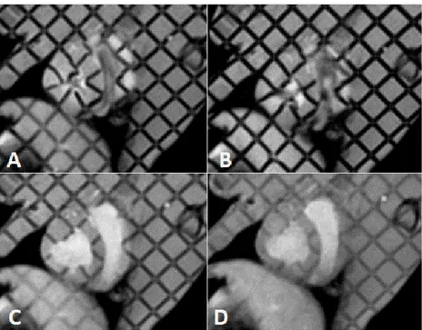 Figure 16: 1.5 T mid ventricular short axis tagging covering the systolic phase of cardiac  cycle