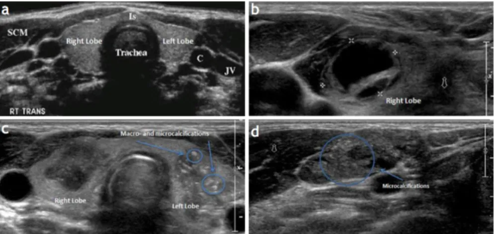 Figure 3.2: Anatomy of the Thyroid Glands in US images. a) Normal appearing glands, b) Complex most probably cys c thyroid nodule in the right thyroid lobe