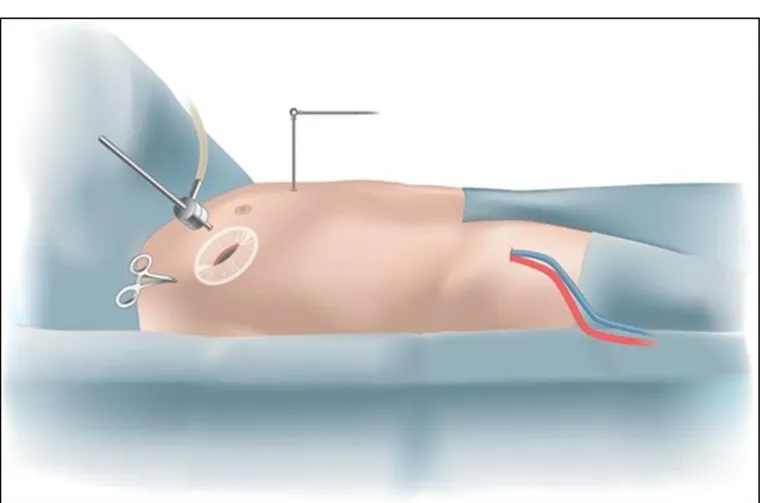 Fig. 6:  Heart-lung bypass representation.  Heart-lung bypass is instituted with small tubes placed in the  femoral artery and vein of the right leg