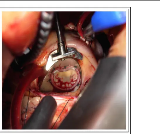Fig. 7: Minimally invasive mitral valve repair or replacement (MIMV) plus/minus tricuspid valve repair via  right  mini  thoracotomy