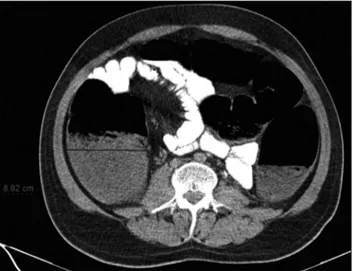Figure  1.  Ogilvie  syndrome  in  a  29-year-old  male. Axial  CT  image obtained  after  oral  and  intravenous  contrast  agent  administration demonstrate dilatation of the colon mostly abundant in cecum