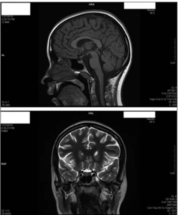 Figure 1. Brain MRI after 10 months of antipsychotic treatment. Figure 2. Brain MRI after 4 months of risperidone discontinuation.