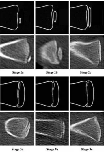 Figure 4. Schematic drawings and pictures of stages 2a-3c of clavicular ossification[45] 