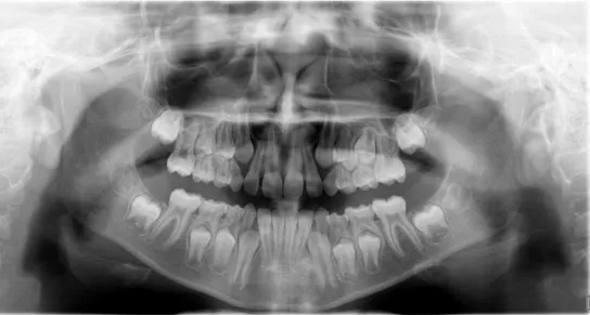 Figure 6.OPG from a 9-year-old subject showing mixed dentition[51] 