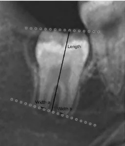 Figure 10:  Example of measurement of a  third molar for I 3 M[66] 