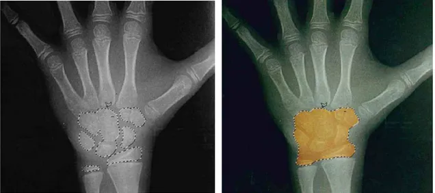 Figura 6 - l’area delle ossa carpali e delle epifisi distali di ulna e radio -Bo- (a sinistra) e l’area totale del  palmo della mano -Ca- (a destra)