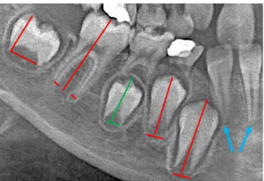 Figura  9  -  Esempio  di  misurazione  degli  apici  aperti  dei  denti;  in  blu  sono  segnalati  i  canali  radicolari  completamente chiusi