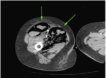FIG. 2 ––CT scan image showing disruption of right quadriceps muscle due to clostridial myonecrosis.