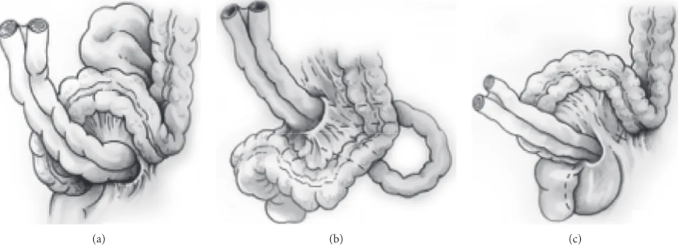 Figure 1: Sigmoid mesocolon hernia is classiﬁed into 3 types: (a) intersigmoid hernia, (b) transmesosigmoid hernia, and (c) intra- intra-mesosigmoid hernia.