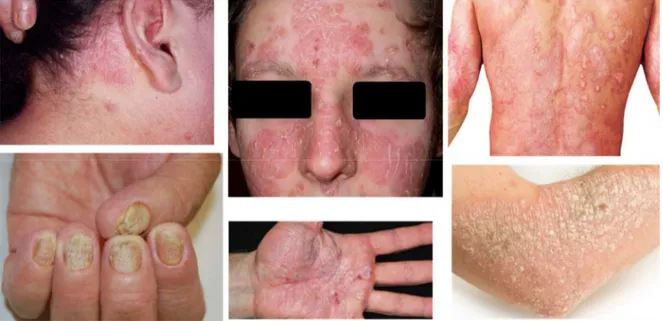 Figure 1. Different body areas affected by psoriasis. 