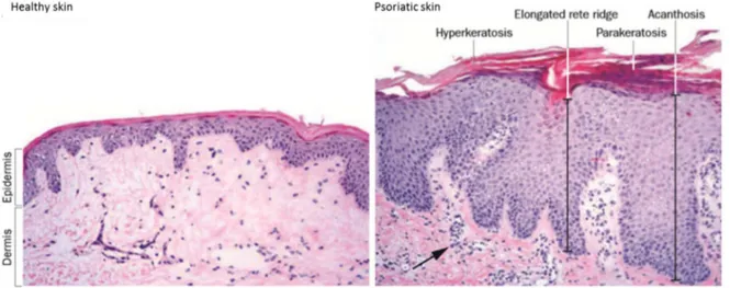 Figure 2. Principal histological features of healthy (left) and psoriatic skin (right; 20x magnification)