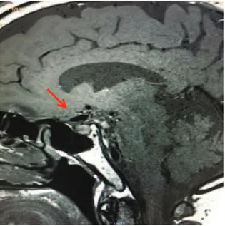 Fig 61: RMN di parete: nessuna presa di contrasto nella parete dell’aneurisma dell’arteria comunicante anteriore 