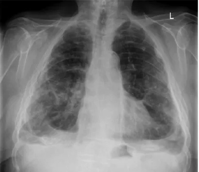 Figure 4. Posteroanterior chest radiograph demonstrating asbestos-related diffuse pleural thickening