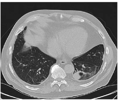 Figure  5.  Computed  tomography  scan  of  the  thorax  demonstrating  asbestos-related  diffuse  pleural 