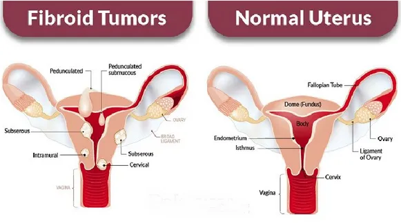 Figure  4.  Schematic  representation  of  the  main  type  of  uterine  fibroids  (subserous,  intramural, 