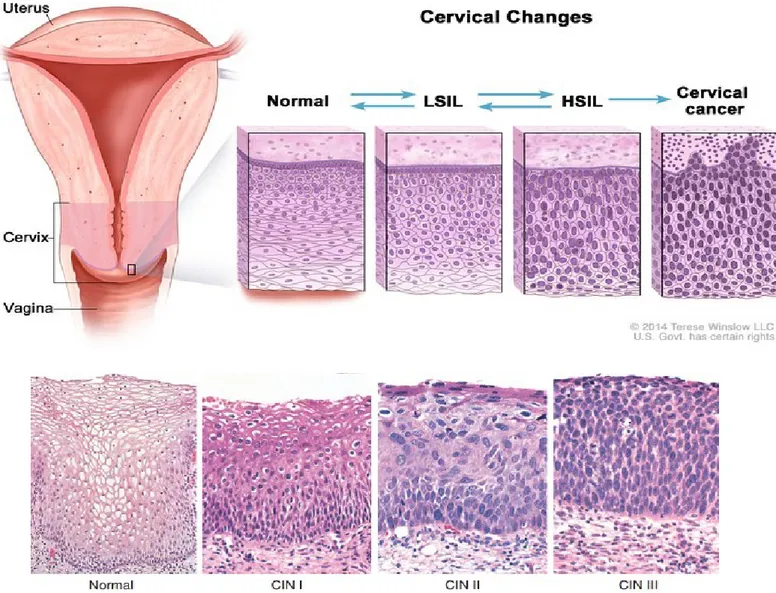 Figure  5.  Representation  of  cervical  changes  in  cervical  intraepithelial  neoplasia  (CIN)