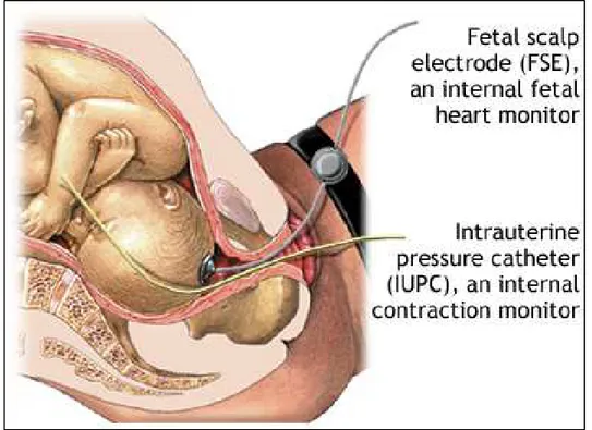Fig. 2.1 . Electrodes configuration for invasive fECG: insertion of the spiral electrode on the fetal scalp 