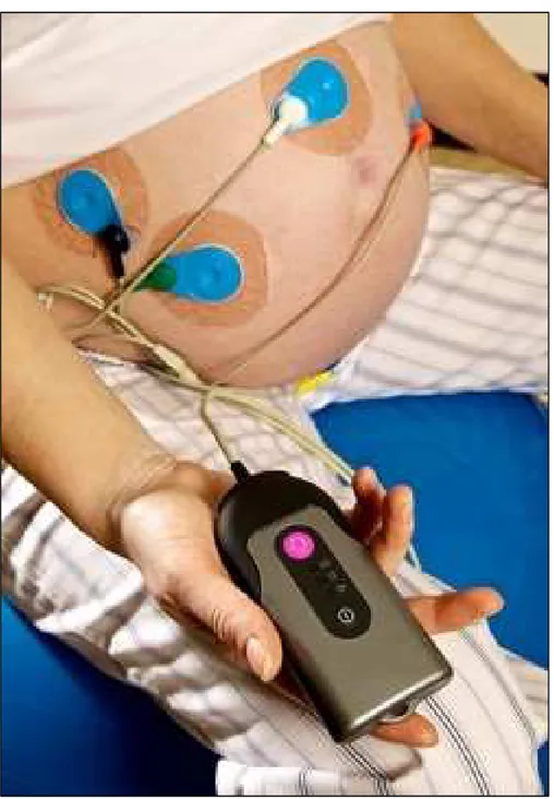 Fig. 2.2.  Electrodes configuration for the non-invasive fECG: positioning the electrodes on the maternal  abdomen 