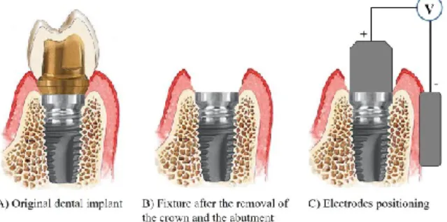Figure 5. Electrodes positioning: after having removed the crown and the abutment (B), the active electrode  is screwed into the fixture, while the neutral one is put in contact with gingiva (C)