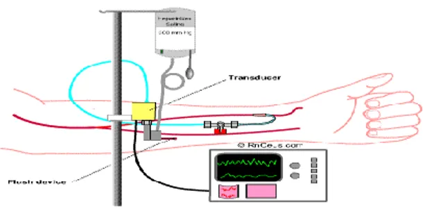 Figure 2: Invasive pressure measurement by means of a catheter 