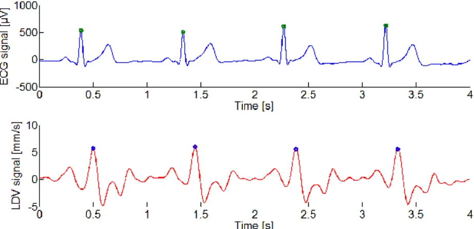 Figure 8: an example of main peak detection in ECG (above) and LDV (below) signals on the carotid site  