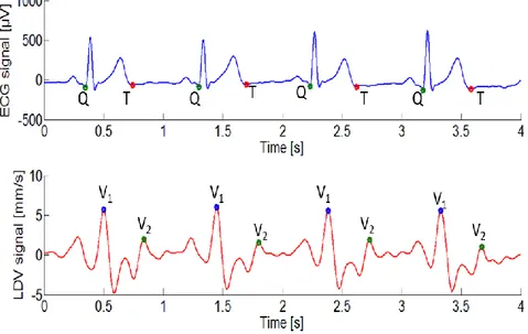 Figure 9: example of QT time interval in ECG signal (above) and V 1 V 2  time interval in LDV signal on the 