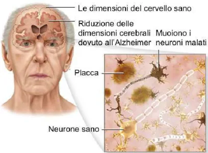 Figura 3. Caratteristiche della malattia di Alzheimer 