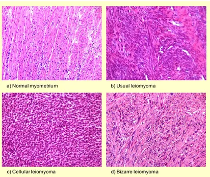 Figure 3. Normal myometrium and different histological types of uterine leiomyoma [11]