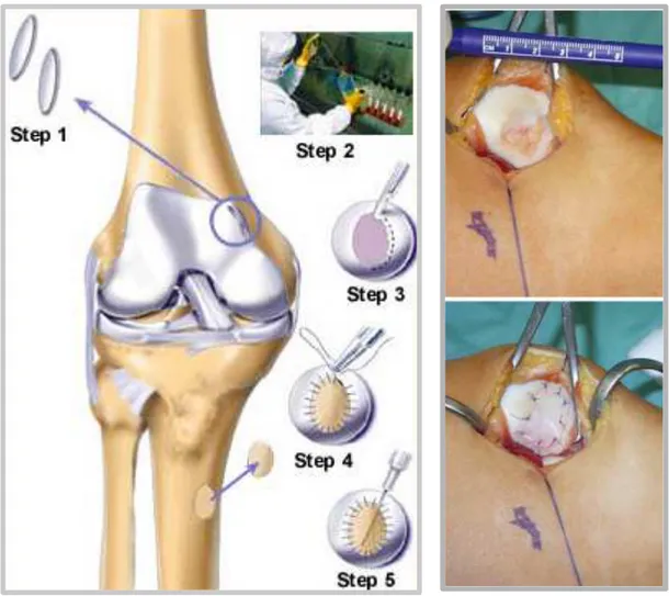 Fig. 1.5.5.1  Autologous chondrocyte implantation (ACI)  