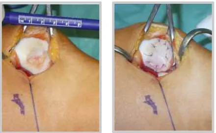 Fig. 1.5.6.1 The matrix assisted chondrocite implantation (MACI) on the patella. From Gigante et al 2009 [29]