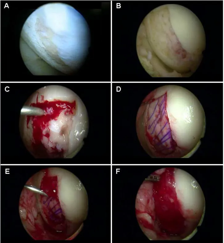 Fig.  3.1  Arthroscopic  CMBMC  technique.  a  The  cartilage  defect  is  identified;  b  debrided  and  microfracture  is 