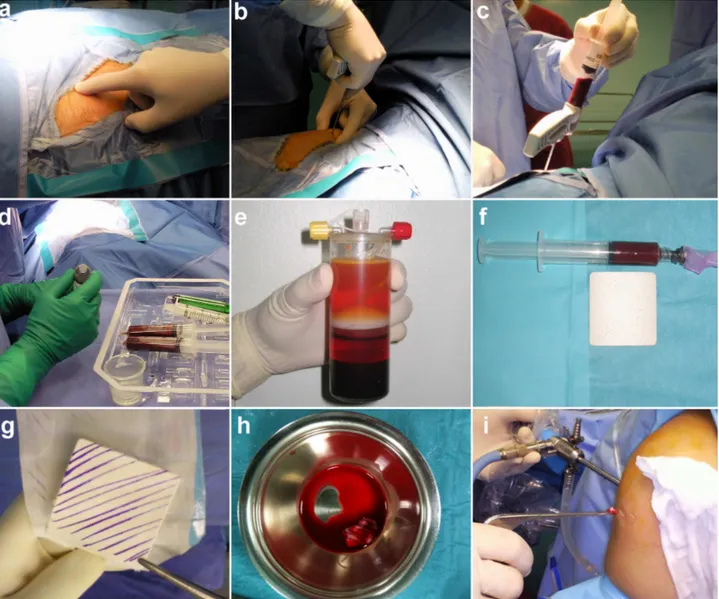 Fig.  4.1  Harvest  phases:  a  iliac  crest  is  identified;  b  Jamshidi  needle  is  inserted;  c  bone  marrow  is  aspirated;  d  two 