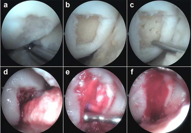 Fig. 4.2 Arthroscopic technique. a The cartilage defect is identified; b debrided; c  microfracture is performed with the 