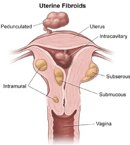 Figure 1 – Location of uterine leiomyomas.