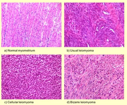 Figure 2 – Normal myometrium and different histological types of uterine leiomyoma (Islam,  Protic et al