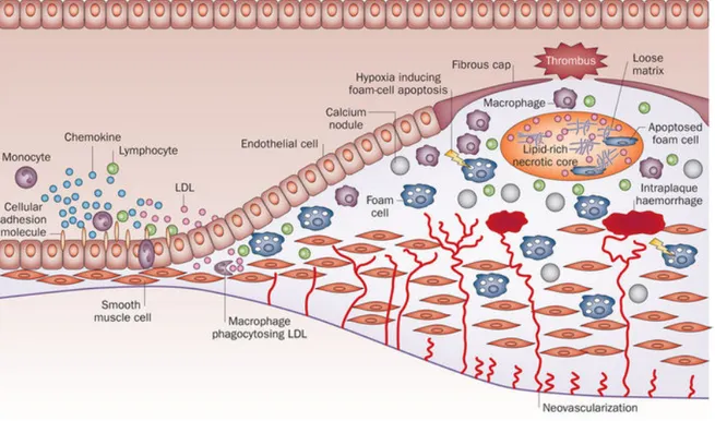 Figura B. Sviluppo della placca aterosclerotica. L’attivazione endoteliale conduce all’espressione di  chemochine e di marker molecolari sulla superficie delle cellule endoteliali, che causa la migrazione e  l’adesione delle cellule immunitarie, inclusi i 