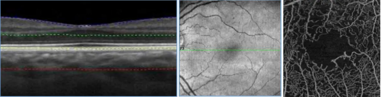 Figure 2: B-scan sectional and en face visualization of a 3×3 3 mm OCTA acquisition centered on the  fovea of a healthy retina.