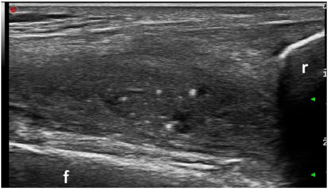 Figura 5. Presenza di ipertrofia sinoviale, con multipli spot iperecogeni intra-articolari,  nel  ginocchio  destro  di  una  paziente  affetta  da  malattia  da  deposito  di  pirofosfato  diidrato di calcio  