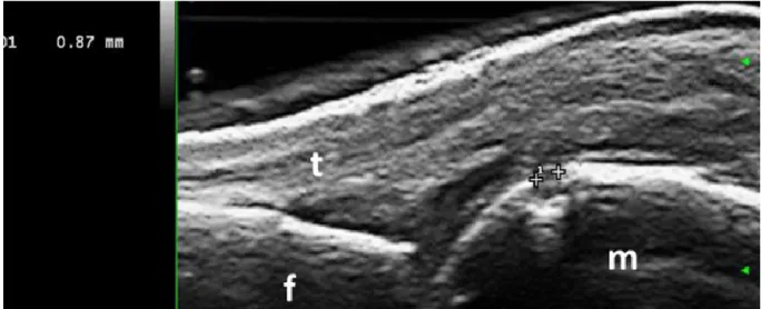 Figura 6. Erosione ossea di piccole dimensioni (0.87 mm di diametro massimo), non  visibile  alla  radiografia  convenzionale,  a  livello  della  II  metacarpofalangea  di  una  paziente affetta da artrite reumatoide  