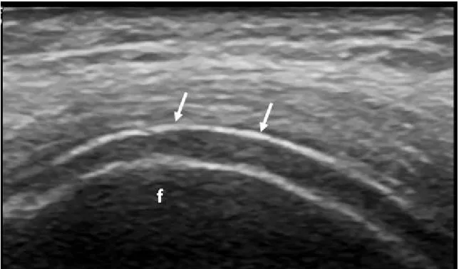 Figura 10. Segno del “doppio contorno” a livello della cartilagine ialina del ginocchio  in paziente affetto da gotta 