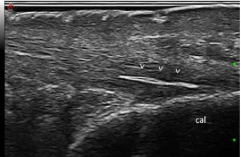 Figura 12. Calcificazione intra-tendinea a livello del tendine di Achille in paziente  con malattia da deposito di pirofosfato diidrato di calcio  