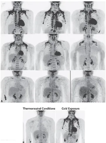 Figura  3:  A.  Risultati  della  PET-CT  in  9  soggetti  mostrano  l'assorbimento 